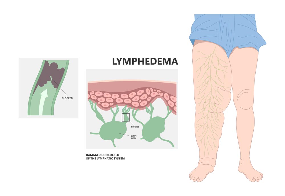 Ein Lymphödem ist eine Verstopfung des Lymphgefäßsystem. An verschiedenen Körperregionen ist der Flüssigkeitsabfluss gestört.